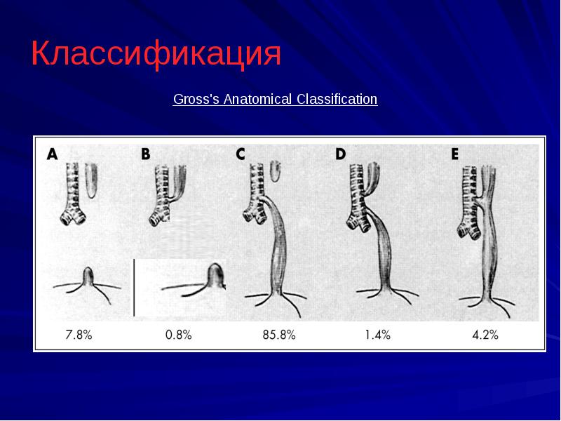 Атрезия пищевода. Атрезия классификация. Атрезия пищевода классификация. Атрезия пищевода классификация атрезия. Классификация атрезии пищевода у детей.