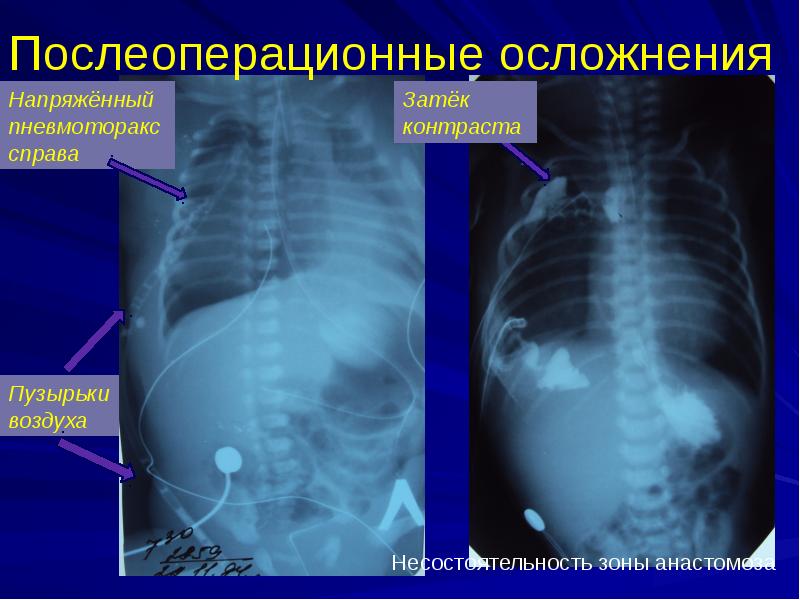 Атрезия пищевода у новорожденных презентация