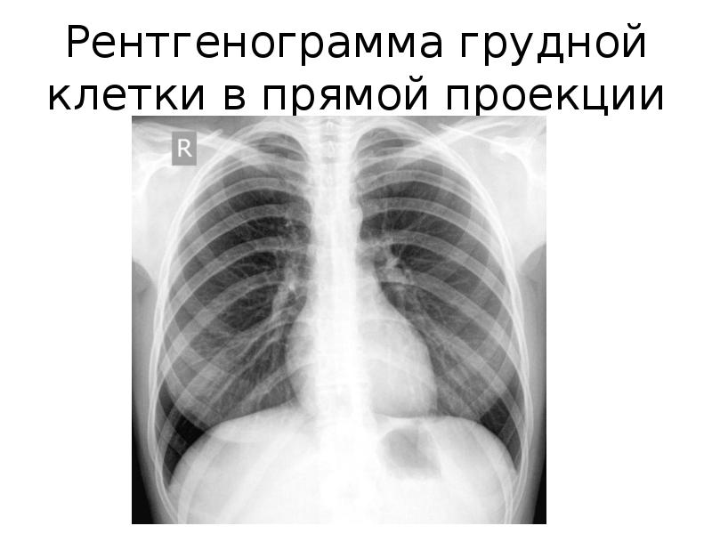 Рентген грудной клетки картинки