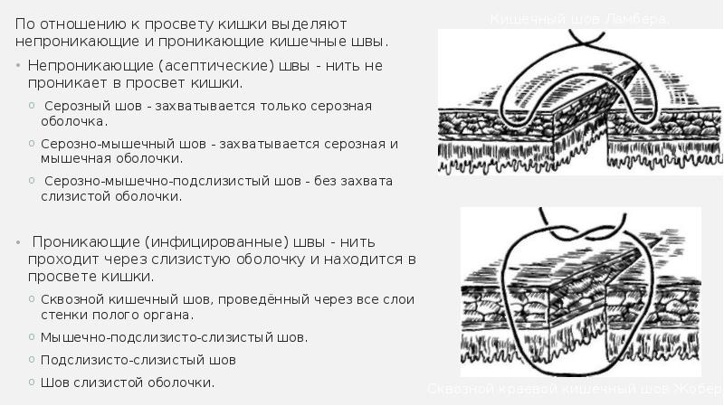 Кишечный шов презентация