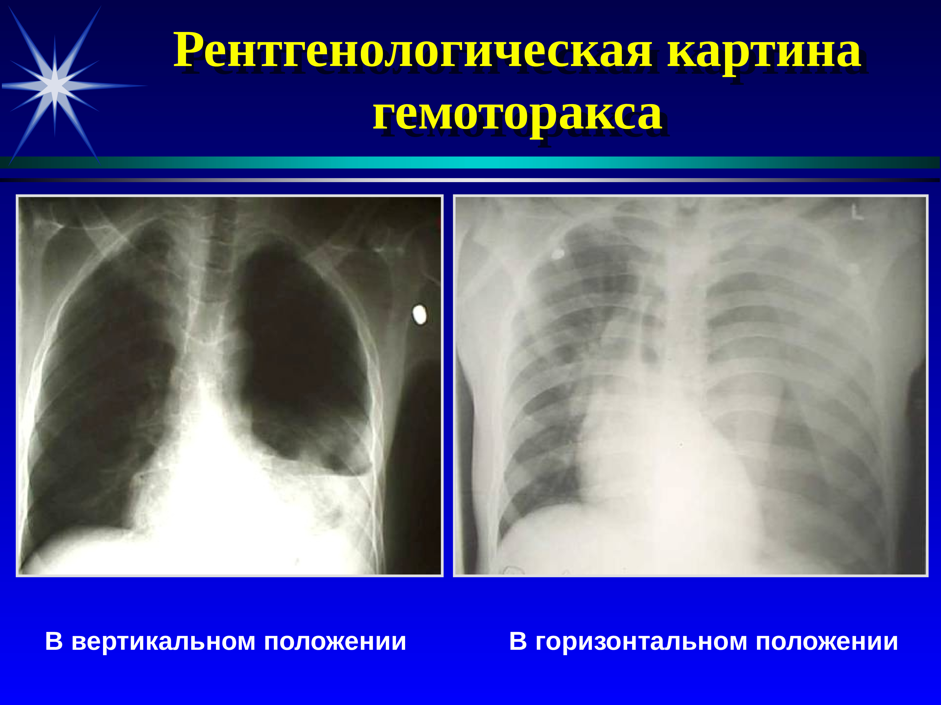 Рентгенологическая картина. Гемопневмоторакс рентген. Пневмогидроторакс рентгенограмма. Гемоторакс легких рентген. Гемоторакс рентгенограмма.