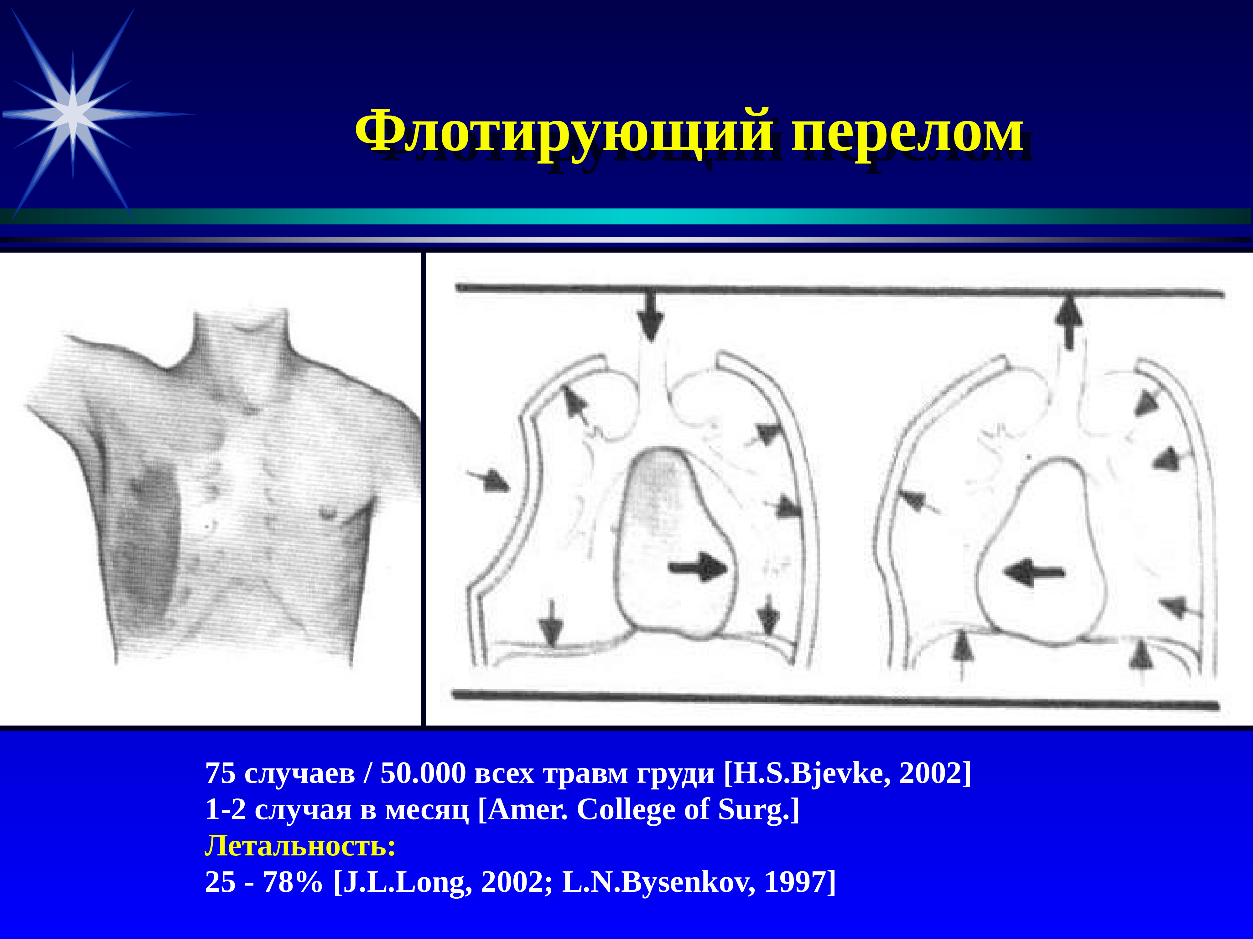 50 случаев. Флотирующий перелом грудной клетки. Флотирующие» повреждения грудной клетки. Флотирующий перелом ребер.