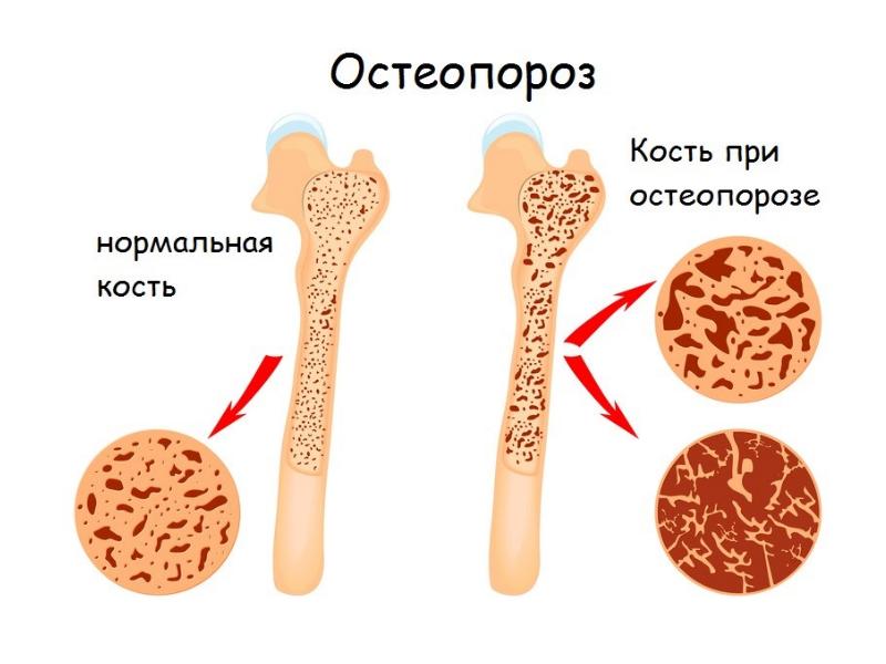 Остеопороз у пожилых в слайдах