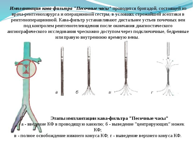 Установка кава фильтра. Имплантация кава-фильтра в нижнюю полую Вену. Постановка кава фильтра при Тэла. Кава фильтр.