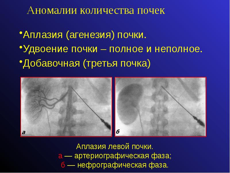 Агенезия венозного. Аплазия почки аномалии. Удвоение почки и добавочная почка.