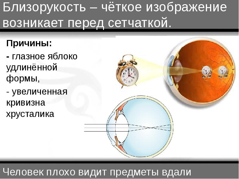 Четкое изображение фокусируется перед сетчаткой это