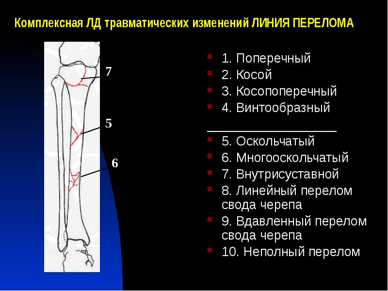 Линейная трещина. Винтообразный перелом большеберцовой кости. Косопоперечный перелом.