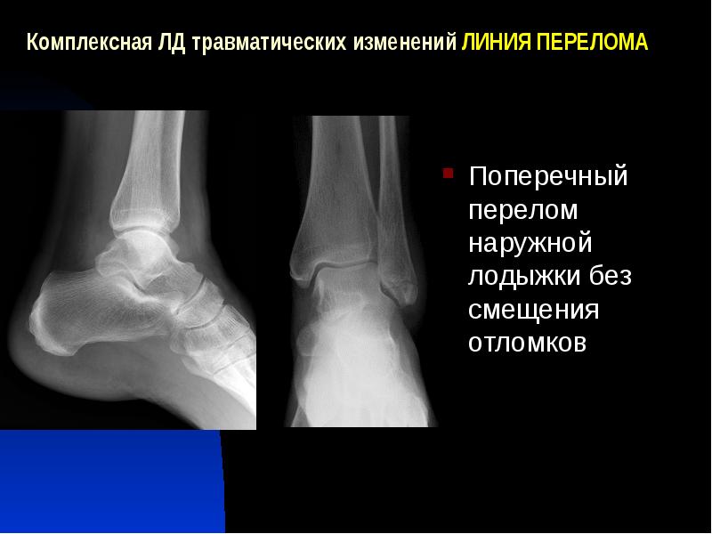 Перелом наружной лодыжки рисунок