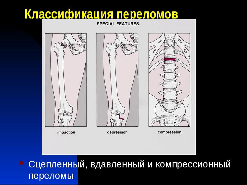 Какой вид травмы скелета изображен на рисунке