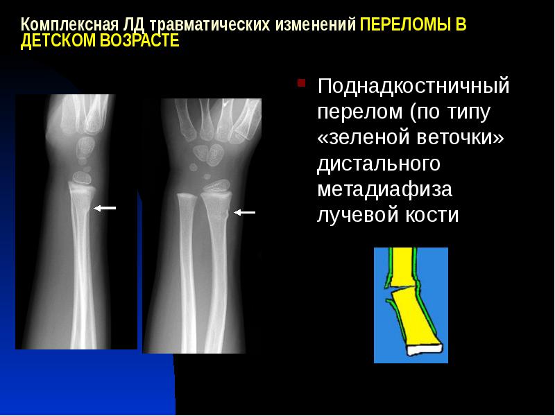 Закрытый перелом лучевой кости карта смп