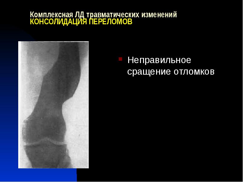 Консолидация перелома. Неправильно консолидирующийся перелом. Причины неправильного сращения отломков. Консолидация отломков в неправильном положении. Трамватическиеконсолидация.