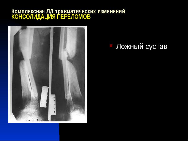 Ложный сустав презентация