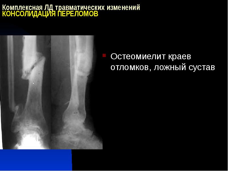 Рентгенодиагностика остеомиелита презентация