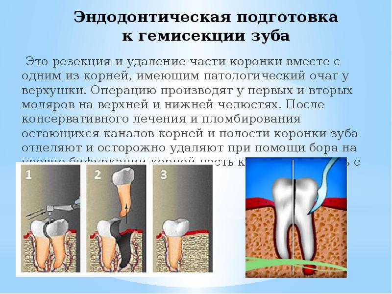 Хирургическое лечение периодонтитов презентация