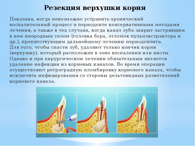 Хирургическое лечение периодонтитов презентация