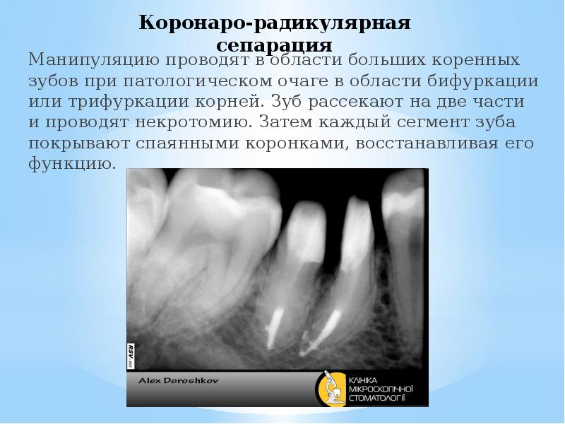 Хирургическое лечение периодонтитов презентация