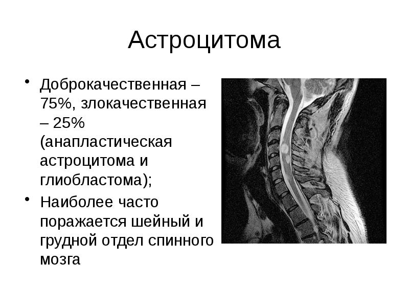 Презентация опухоль спинного мозга