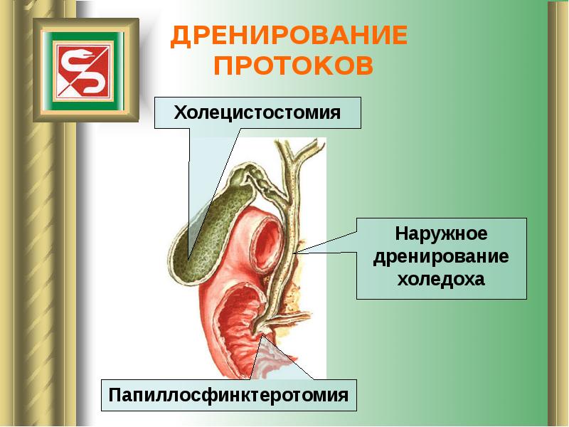 Панкреатит факультетская хирургия презентация