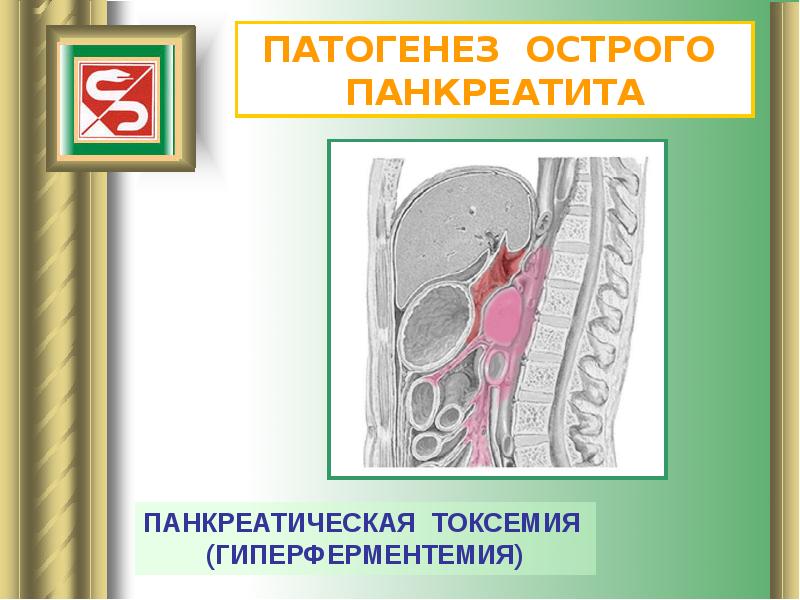 Панкреатит факультетская хирургия презентация