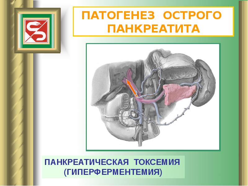 Панкреатит факультетская хирургия презентация