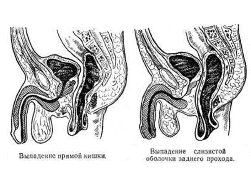 Выпадение прямой кишки презентация