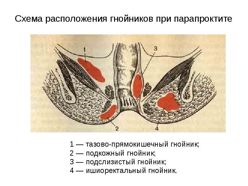 Парапроктит симптомы у мужчин фото Хирургические заболевания прямой кишки