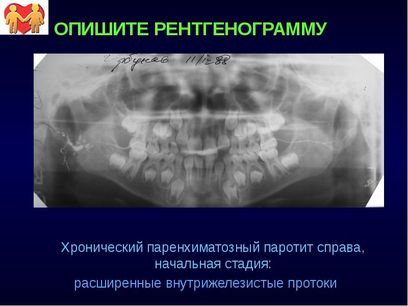 Хронический паренхиматозный паротит у детей презентация