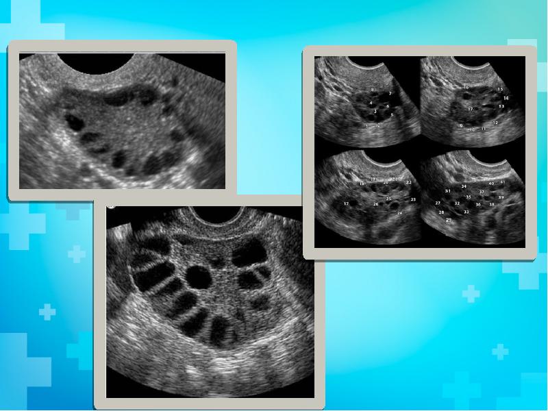 Мфя в гинекологии. Синдром Штейна-Левенталя (поликистоз яичников). Поликистоз яичников патанатомия. Хронический поликистоз. Клиническая картина поликистоза яичников.
