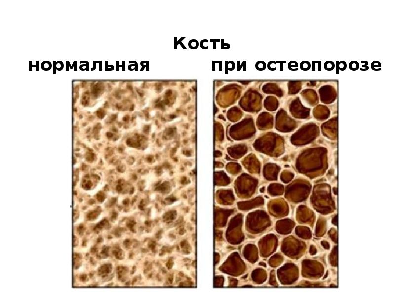 Центр остеопороза. Нормальная кость и кость при остеопорозе. Пористость костей. Изменение костей при остеопорозе. Остеопороз патологическая анатомия.