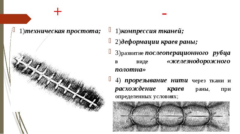 Хирургические швы презентация