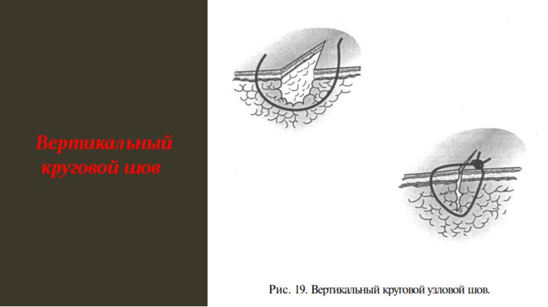 Хирургические швы презентация