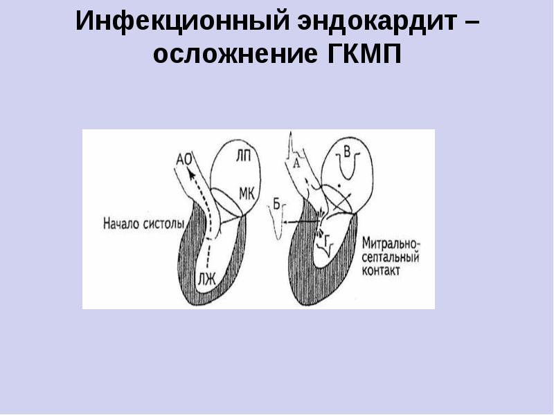 Инфекционный эндокардит факультетская терапия презентация