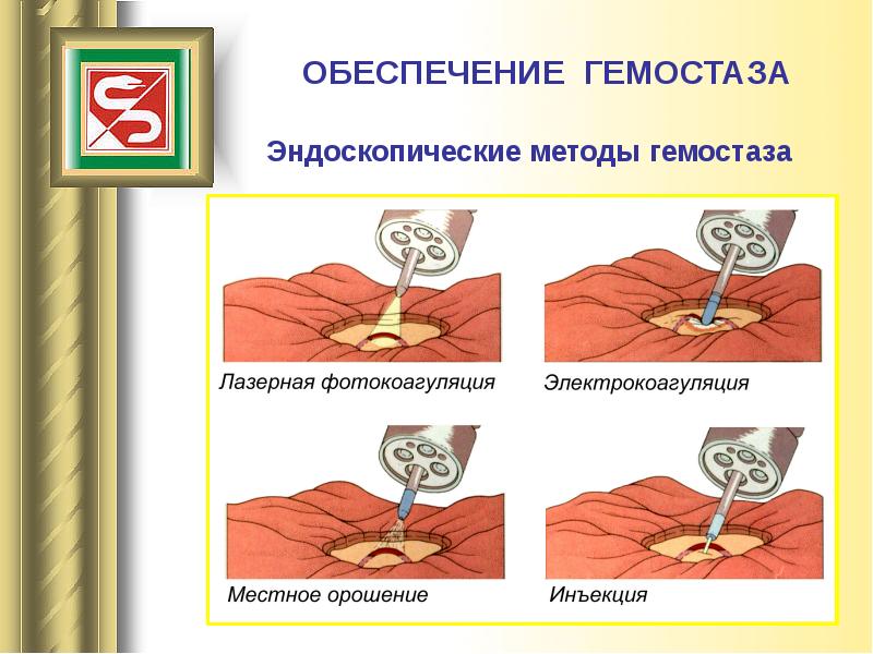 Гемостаз презентация по хирургии