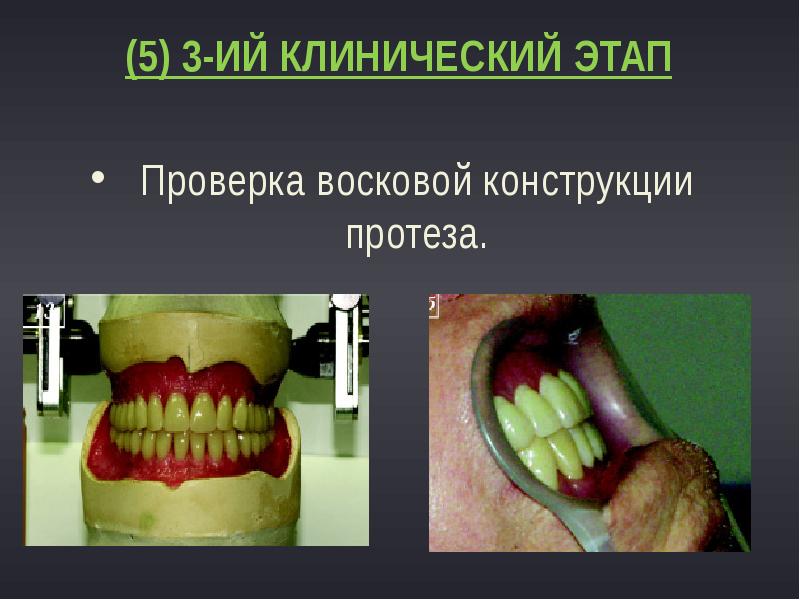 (5) 3-ИЙ КЛИНИЧЕСКИЙ ЭТАП
Проверка восковой конструкции протеза. (5) 3-ИЙ КЛИНИЧЕСКИЙ ЭТАП
Проверка восковой конструкции протеза.