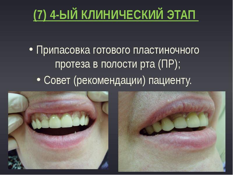 (7) 4-ый клинический этап
Припасовка готового пластиночного протеза в полости (7) 4-ый клинический этап
Припасовка готового пластиночного протеза в полости