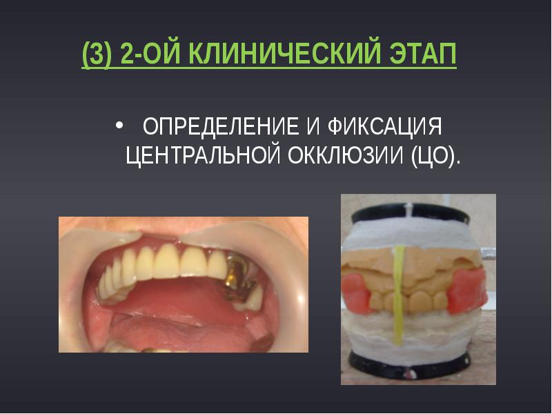 Определение и фиксация центральной окклюзии (ЦО).
(3) 2-ОЙ КЛИНИЧЕСКИЙ ЭТАП Определение и фиксация центральной окклюзии (ЦО).
(3) 2-ОЙ КЛИНИЧЕСКИЙ ЭТАП