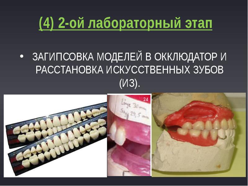 Загипсовка моделей в окклюдатор и расстановка искусственных зубов (ИЗ).
(4) 2-ой Загипсовка моделей в окклюдатор и расстановка искусственных зубов (ИЗ).
(4) 2-ой