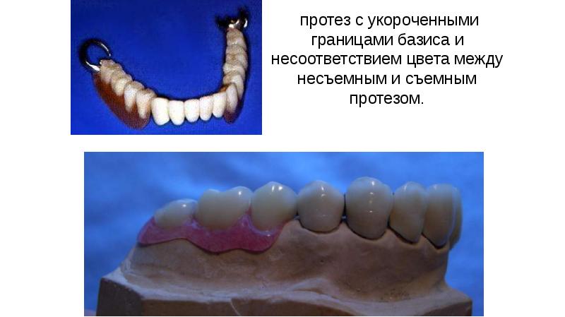 Съемные протезы презентация