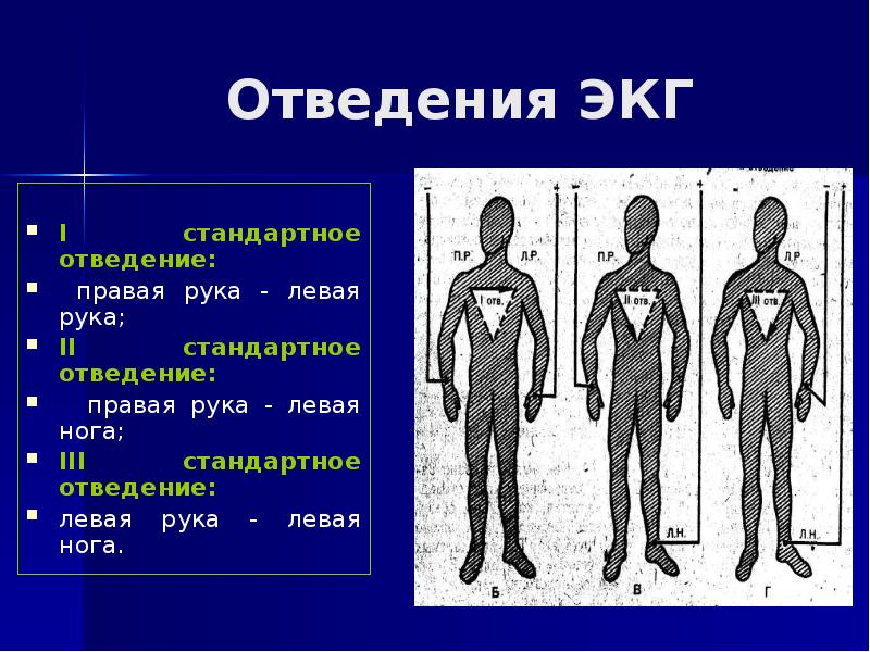 Правые грудные. Правые отведения на ЭКГ. Правые и левые отведения на ЭКГ. Левые отведения ЭКГ. Левые и правые грудные отведения на ЭКГ.