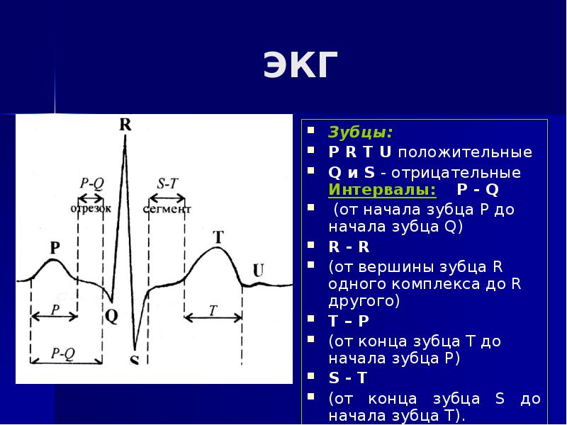 Зубцы экг. ЭКГ Нора и подъем зубца St. Основные элементы ЭКГ. ЭКГ норма зубец r v + s. ЭКГ С зубец r отрицательно.