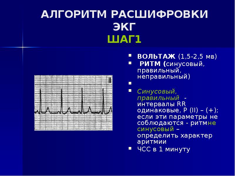 Что значить синусовый ритм. Нормальная ЭКГ синусовый ритм синусовый. Вольтаж зубца r на ЭКГ. Кардиограмма сердца синусовый ритм норма. ЭКГ расшифровка синусовый ритм.
