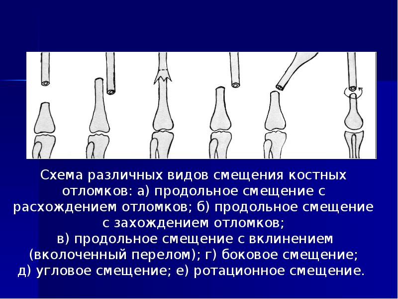 Какой сустав изображен. Классификация смещений костных отломков. Рентгенодиагностика травматических повреждений костей и суставов. Рентген типы смещения костных отломков. Какой сустав изображён на рентгеновском снимке.