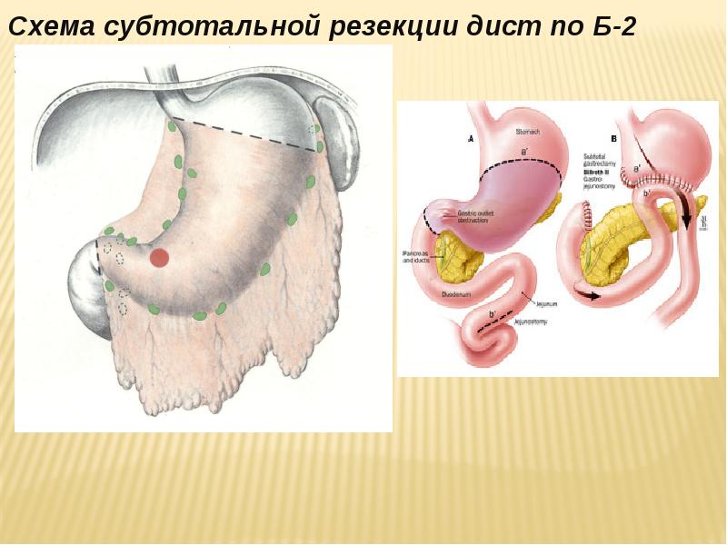 Проксимальная резекция желудка схема операции