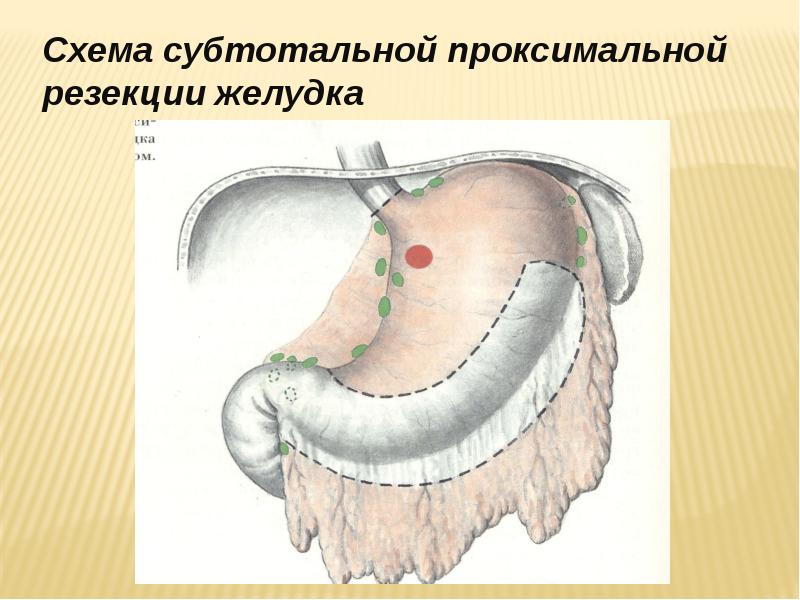 Последствия резекции желудка. Субтотальная резекция желудка. Проксимальный отдел желудка. Проксимальная резекция желудка. Проксимальная резекция желудка схема.