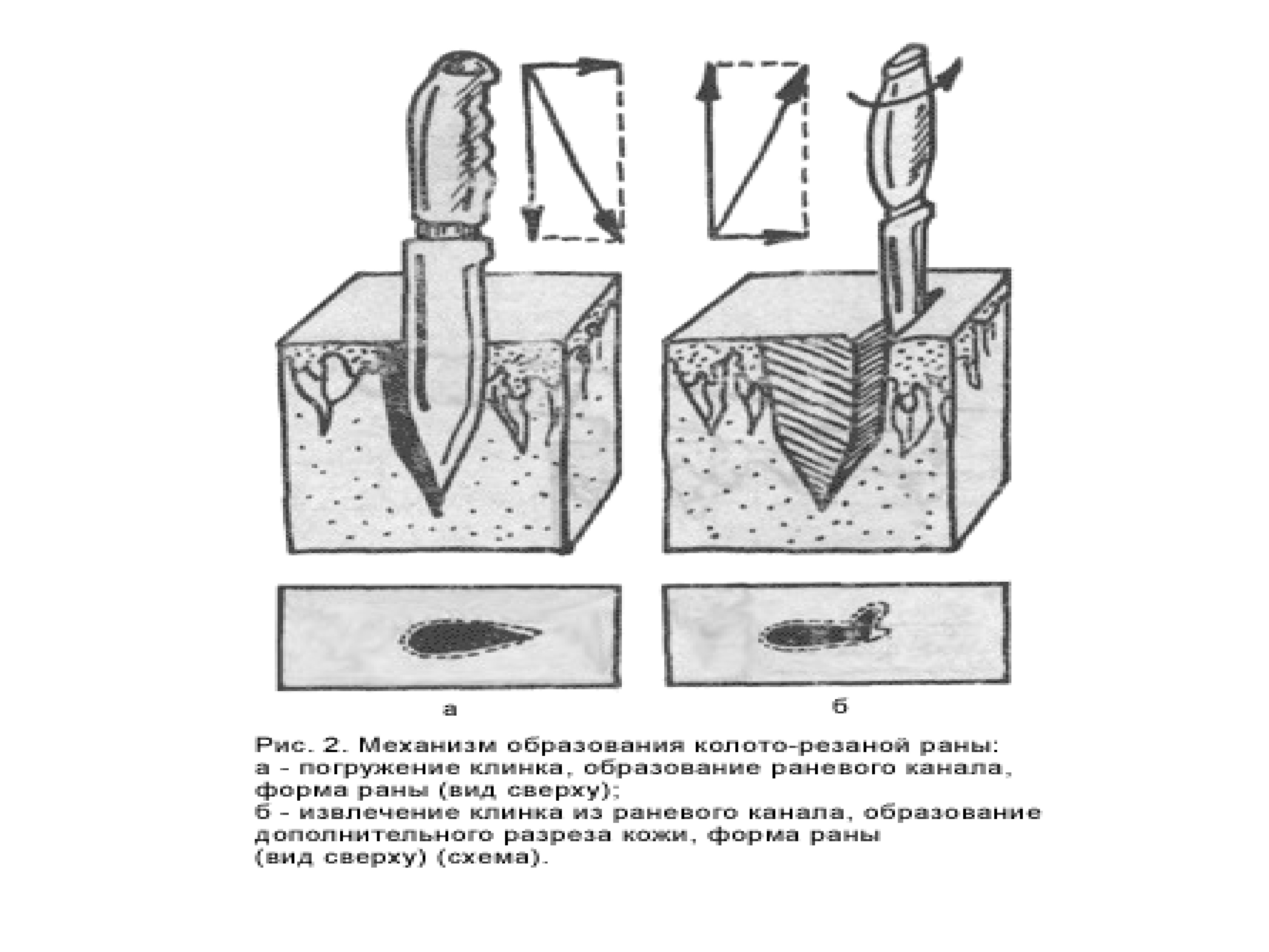 Веретенообразная форма раны. Неправильная форма раны. Веретенообразная форма раны. Повреждения веретенообразной формы. Формы колото-резаных ран.