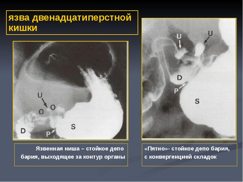 Язвенная болезнь желудка стол 1