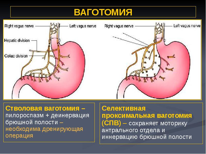 Язвенная болезнь желудка фото