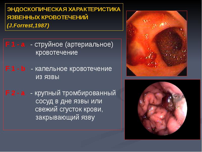 Язвенная болезнь желудка стол 1