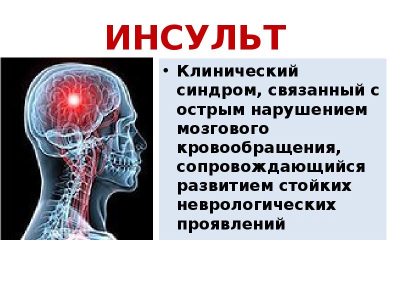 Клинический инсульт. Клинический инсульт мозга. Инсульт определение. Инсульт сообщение по биологии 8.