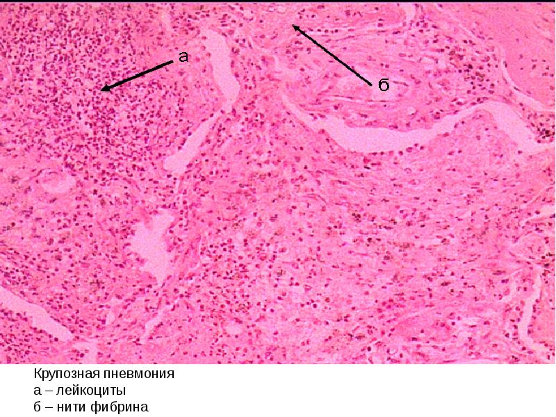 Крупозная пневмония патологическая анатомия презентация
